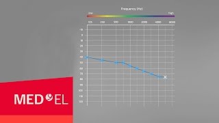 Audiograms Explained  MEDEL [upl. by Semela]