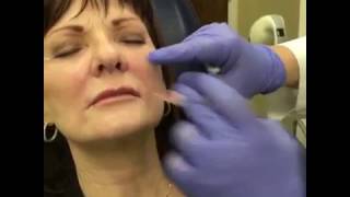 Restylane L Filler for Nasolabial Folds Wrinkle Treatment [upl. by Nemracledairam82]