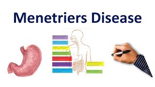 Menetriers Disease Made Easy USMLE Step 1 NCLEX COMLEX [upl. by Amles693]