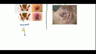 Hemorrhoids Lecture for USMLE [upl. by Natanoy286]