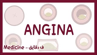 Angina stable angina angina pectoris unstable angina vasospastic prinzmetal angina عربي [upl. by Ramiah]