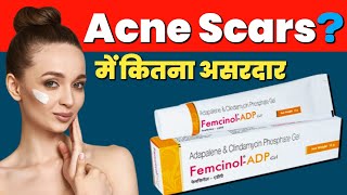 Adapalene Gel On Face  Femcinol ADP  Clindamycin Phosphate Gel  Acne Scars Treatment [upl. by Verity509]