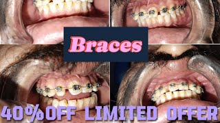 Ortho Braces Price in PakistanTooth Braces Cost in IslamabadBraces Before ampAfterBraces Process [upl. by Eirol63]