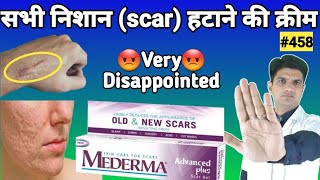 Mederma cream  mederma for acne scars  mederma advanced scar gel review [upl. by Jilleen812]