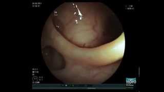 Colonic Diverticulosis [upl. by Sandra]