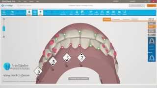 Invisalign ClinCheck Pro Tutorial contatos oclusales  Ortodoncia Friedländer Barcelona [upl. by Euqinehs]