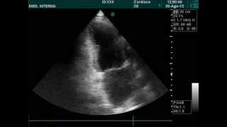 Apical hypokinesis echocardiography doppler ultrasound [upl. by Enirhtac]