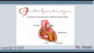 Extrasystole  Premature contraction  atrial nodal and ventricular extrasystole [upl. by Norrat285]