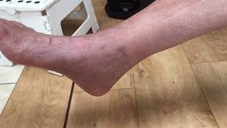 Recover Faster MustDo Exercises with Injured Foot or Ankle [upl. by Camp694]