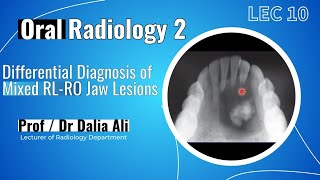 Oral Radiology 2  Lec 10  Differential Diagnosis of Mixed RL  RO Jaw Lesions [upl. by Enyluqcaj186]