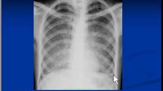 Chest xray interpretation  Miliary Tuberculosis [upl. by Stroup]