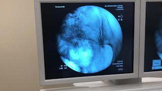 IntraArticular Injection of the Sacroiliac Joint Under Fluoroscopic Guidance [upl. by Aicenek]