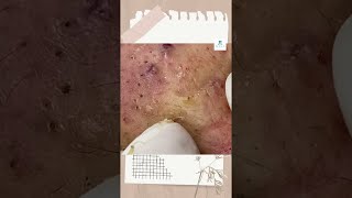 Big Cystic Acne Blackheads Extraction Blackheads amp Milia Whiteheads Removal Pimple Popping shorts [upl. by Latsyrcal]