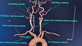 BRAIN AND NECK ANGIOGRAPHY On ct scanALL ABOUT ANGIOGRAPHYPART2CONCEPT ON ANGIOGRAPHY [upl. by Nanji]