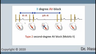 Third Degree AV Block  Complete Heart Block on Hospital Monitor cardiology [upl. by Lelith804]