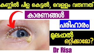 കുഞ്ഞിന്റെ കണ്ണിലെ പഴുപ്പ്Eye Discharge In Babies MalayalamHome remedy for Watery Eyes [upl. by Suolevram257]