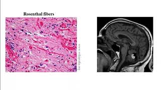 USMLE ACE Video 200 Classification and Pathophysiology of Common Adult and Pediatric Brain Tumors [upl. by Ydnyc943]