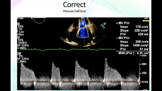 Mitral Stenosis Echocardiographic Assessment [upl. by Htebasil931]