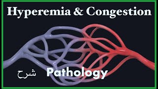 Pathology  Congestion amp Hyperemia  Hemodynamic blood disorders 3 شرح باثو [upl. by Eirotal]