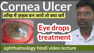 cornea ulcer treatment  cornea foreign body  corneal ulcer treatment  cornea ulcer eye drops [upl. by Corvese]