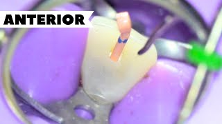 Anterior Root Canal Treatment  Maxillary Anterior Access [upl. by Aytac]