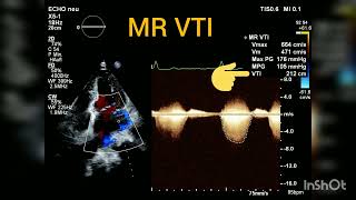 How to quantify Mitral regurgitation with PISA method [upl. by Nosoj764]