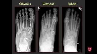 Tarsometatarsal Joints and Midfoot Lisfranc Sprains [upl. by Ettennal]