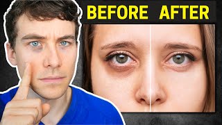 The Truth about Dark Circles Causes and Proven Treatments [upl. by Naesal]