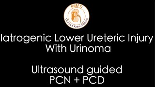 Iatrogenic Lower Ureteric Injury With Urinoma  Ultrasound guided PCN  PCD [upl. by Guy449]