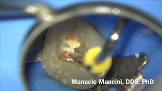 Dr Manuele Mancini  Endodonzia Primo Molare Superiore  Endodontics Upper First Molar [upl. by Ivetts]