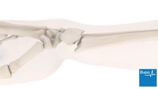 How a wrist fracture is treated  Bupa Health [upl. by Tarton]