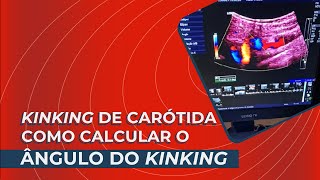 Kinking de Carótida  Como Calcular o ângulo do Kinking [upl. by Ttelrats562]