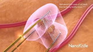 NanoKnife System Ablation Animation [upl. by Cy]