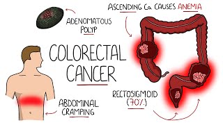 Understanding Colorectal Cancer Includes Polyps [upl. by Blondell152]