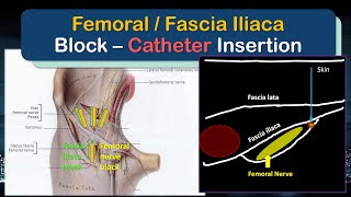 Femoral Nerve  Fascia Iliaca Block Catheter  A quotHowToquot Guide to Insertion [upl. by Aicined]