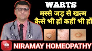 मस्से को जड़ से हटाने के उपाय  Home remedies for warts 100 effective [upl. by Riocard]