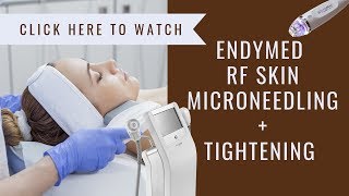 EndyMed RF Skin Tightening  Microneedling at Avery Graham Aesthetics [upl. by Ayardna58]