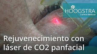 Rejuvenecimiento con láser de CO2 panfacial 17045 [upl. by Anilatak304]