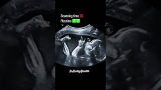 Ultrasound scan pregnancy [upl. by Nennek]