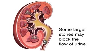 How Kidney Stones Are Formed Animation  Renal Calculi Causes amp Symptoms Video  Blocked Urine Flow [upl. by Assirt]