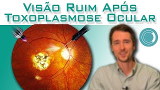 Toxoplasmose Ocular  visão embaçada após o tratamento [upl. by Anelat]