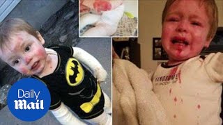 Boy has genetic disorder causing his skin to blister when touched [upl. by Nikaniki]