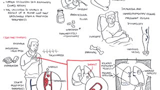 Pulmonary Embolism  Overview [upl. by Yduj]