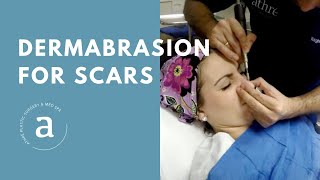 Dermabrasion for Scars  Live Demo by Dr Athre [upl. by Bravar]