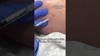 How a dermatologist treats stubborn spider veins on legs shorts [upl. by Deerc]