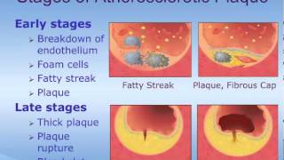 Acute Coronary Syndrome ACS  How it Happens [upl. by Banky725]