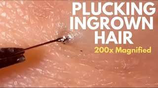 Plucking Black Long Ingrown Hair From Underneath Skin Slimy Wet Tip at 200x Magnified 毛发内生 [upl. by Enahc]