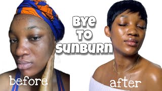 HOW TO CLEAR SUNBURN FAST• GET RADIANT AND BRIGHTER SKIN [upl. by Rese407]