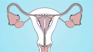 Hormonal coil IUS [upl. by Muriel]