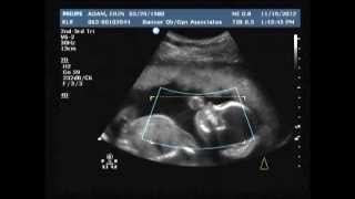 20 week ultrasoundIts A GIRL [upl. by Airbas]